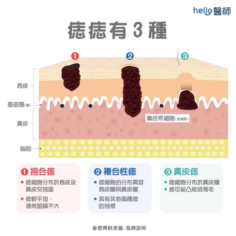 臉頰長痣代表什麼|痣變大、痣多或長毛會變皮膚癌？認識痣的形成與原因